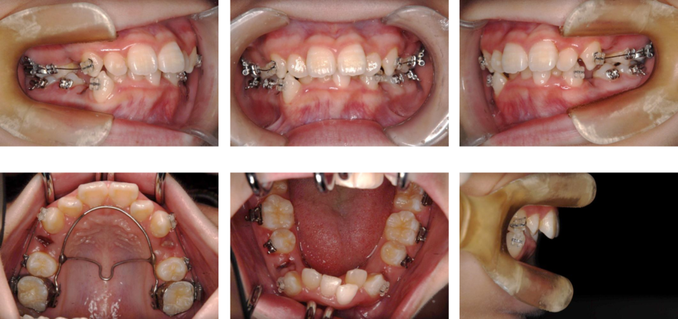 治療例 叢生 がたがた じん歯科 まや矯正歯科クリニック 矯正部門