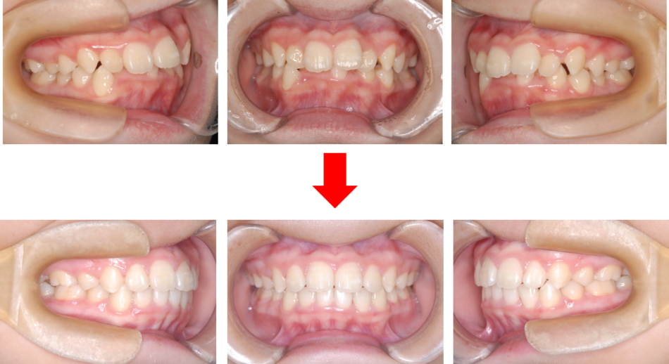 治療例 叢生 がたがた じん歯科 まや矯正歯科クリニック 矯正部門