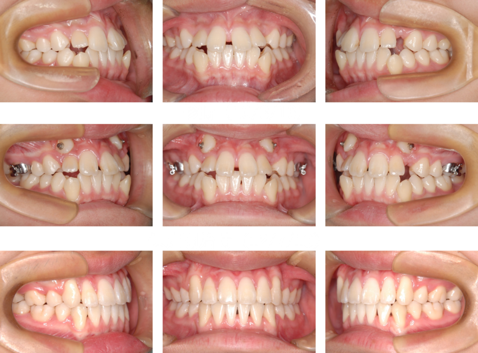 治療例 埋伏歯 じん歯科 まや矯正歯科クリニック 矯正部門