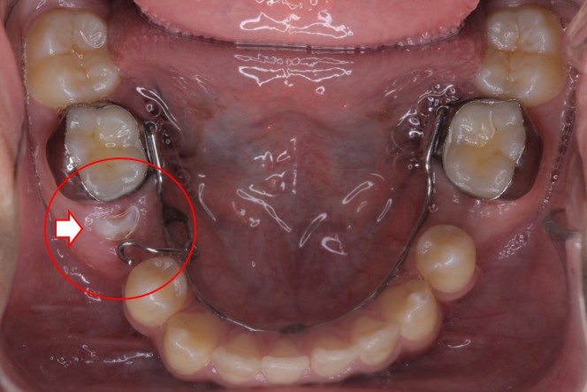 埋まっている歯をどうする じん歯科 まや矯正歯科クリニック 矯正部門